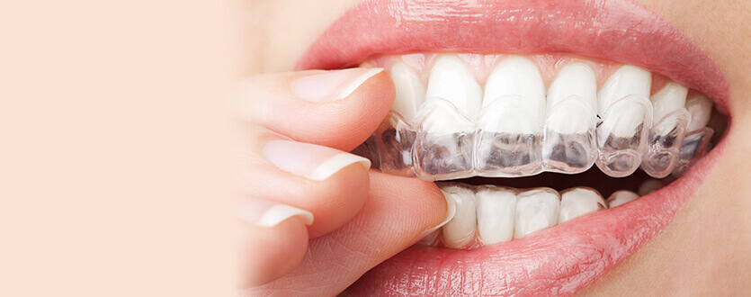 Often Invisalign Teen Is Practically 64