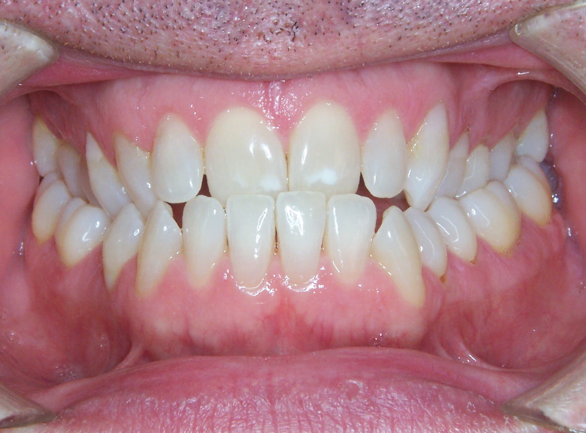 Paul-Parkenson-Underbite-Adult-Before-Center.jpg