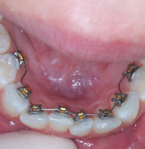 Lingual Braces Raleigh, Garner & Cary Lingual Braces Cary Raleigh Garner