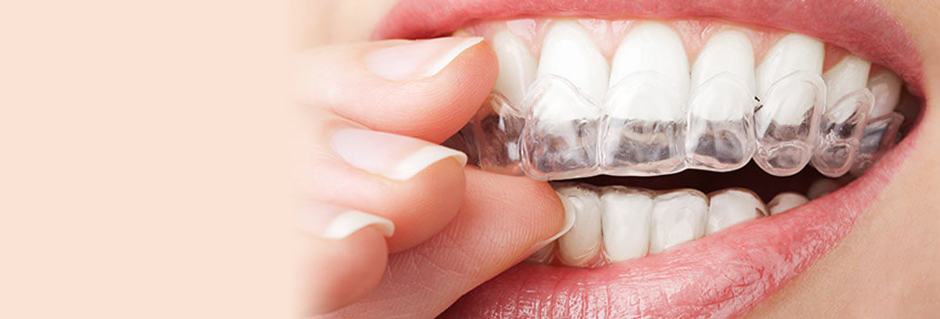 invisalign