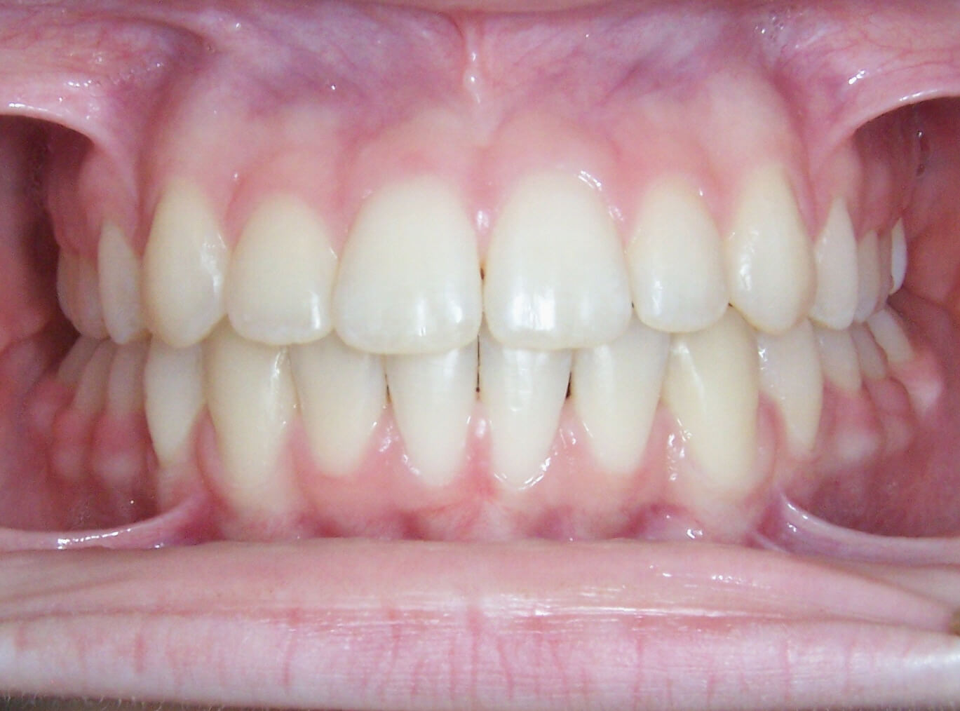 How to Get Straight Teeth With Lingual Braces