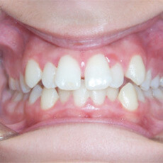 Crowded teeth