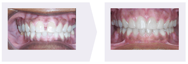 Gap Teeth Before and after